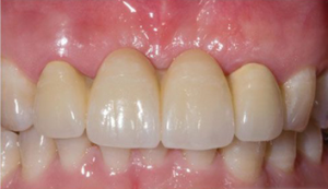 Image of Patients Teeth After Bridge