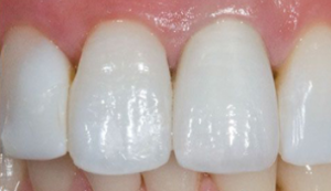 Image of Patients Teeth After Crown Procedure