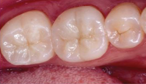 Image of Patients Teeth After Filling Procedure
