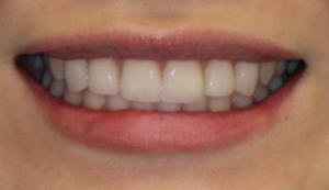 Image of Patients Teeth After Veneer Procedure