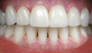 Image of Patients Teeth After Whitening Procedure