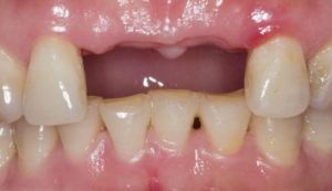 Image of Patients Teeth Before Bridge
