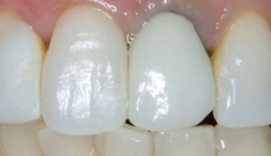 Image of Patients Teeth Before Crown Procedure