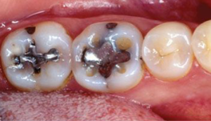 Image of Patients Teeth Before Filling Procedure