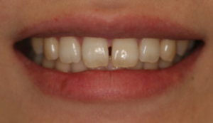 Image of Patients Teeth Before Veneer Procedure