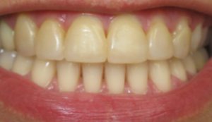 Image of Patients Teeth Before Whitening Procedure