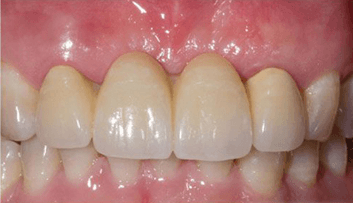 Image of Patients Teeth After Bridge