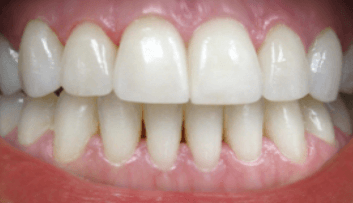 Image of Patients Teeth After Whitening Procedure