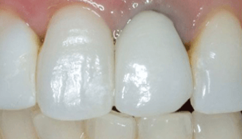Image of Patients Teeth Before Crown Procedure